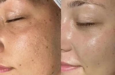 beaforeafter-woman-face1